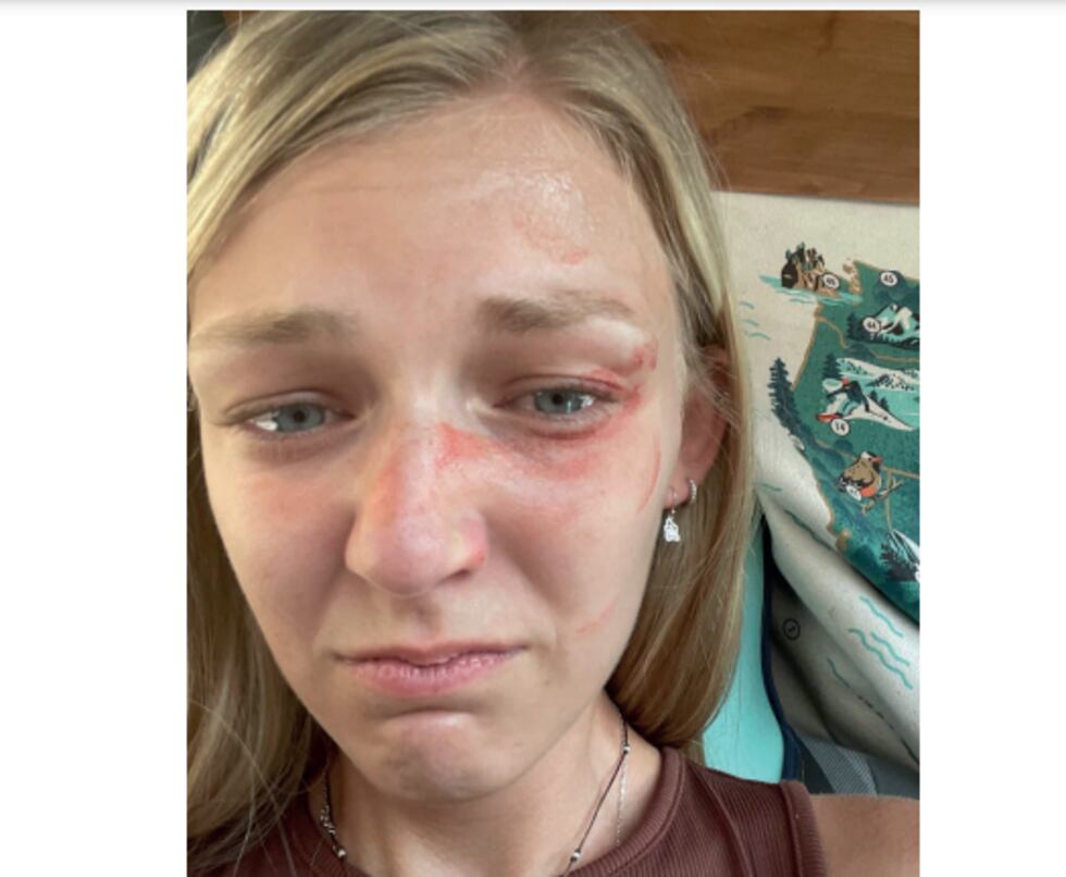 Photo taken by Gabby Petito shows injuries to her face prior to a domestic violence traffic stop.